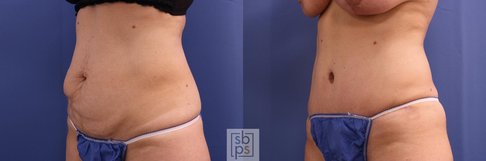 Before & After Tummy Tuck Case 385 Left Oblique View in Torrance & Los Angeles, CA, CA