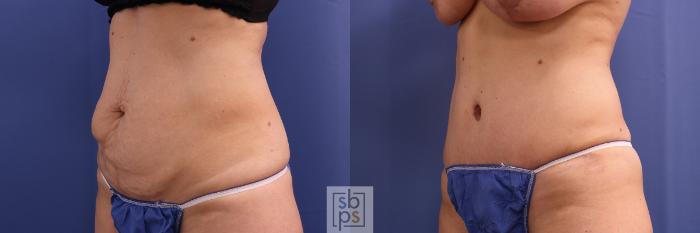 Before & After Tummy Tuck Case 385 Left Oblique View in Torrance, CA