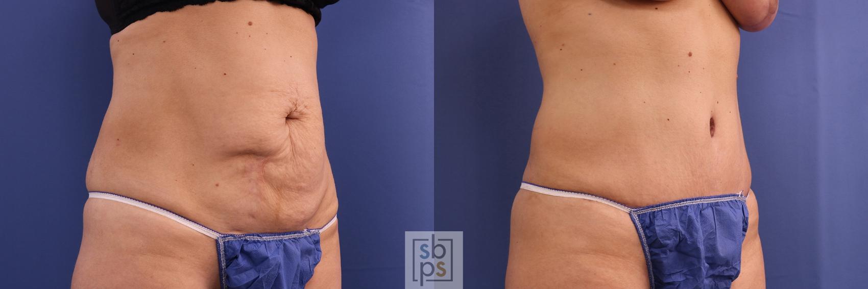 Before & After Tummy Tuck Case 385 Right Oblique View in Torrance & Los Angeles, CA, CA