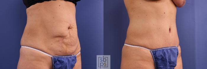 Before & After Tummy Tuck Case 385 Right Oblique View in Torrance, CA
