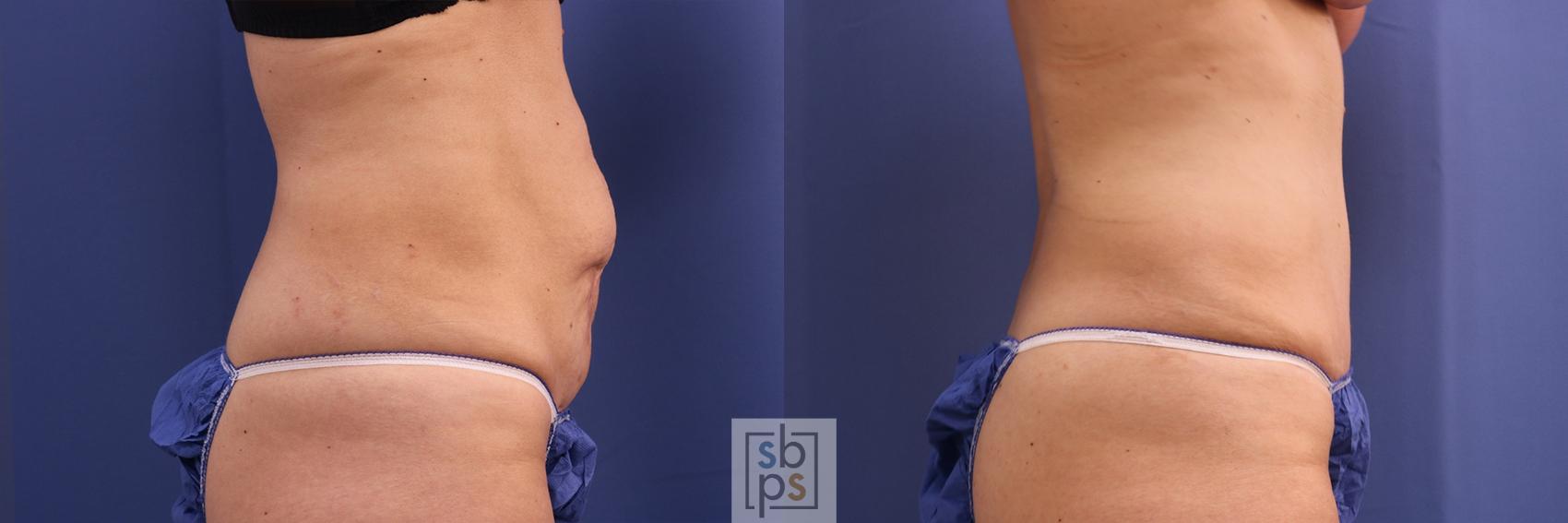 Before & After Tummy Tuck Case 385 Right Side View in Torrance & Los Angeles, CA, CA