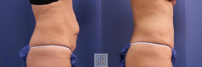 Before & After Tummy Tuck Case 385 Right Side View in Torrance, CA