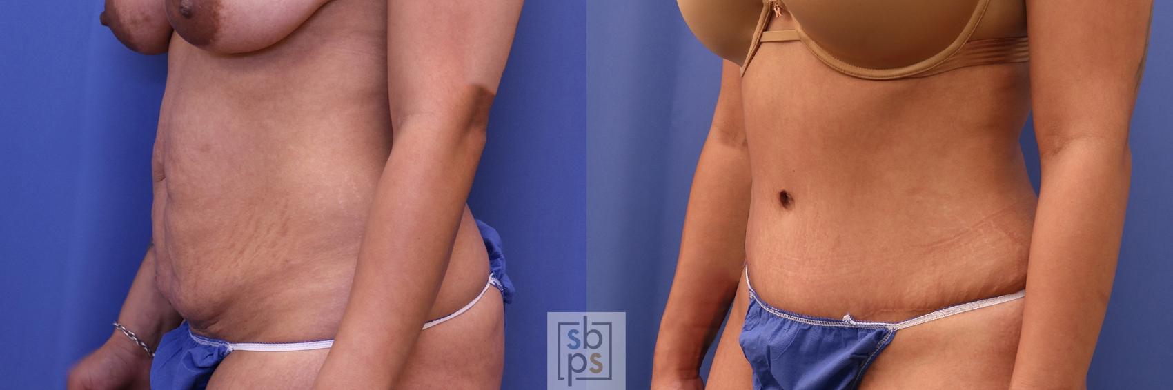 Before & After Tummy Tuck Case 394 Left Oblique View in Torrance & Los Angeles, CA, CA