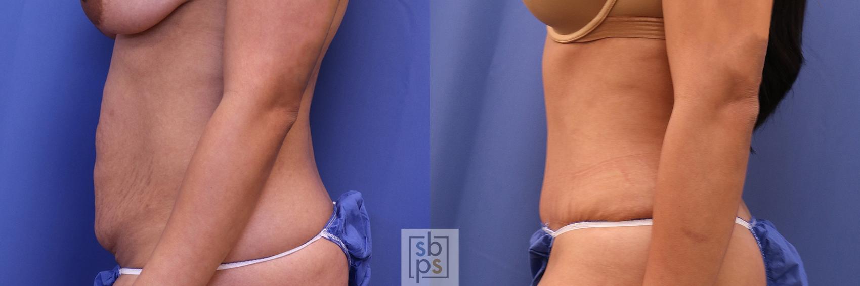 Before & After Tummy Tuck Case 394 Left Side View in Torrance & Los Angeles, CA, CA