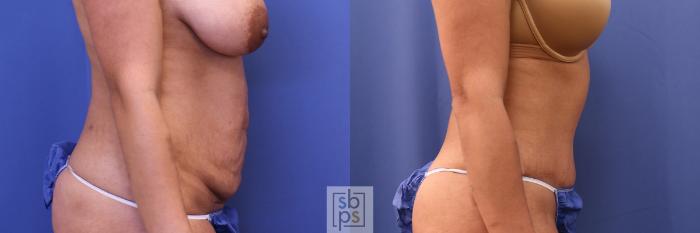 Before & After Liposuction Case 394 Right Side View in Torrance, CA