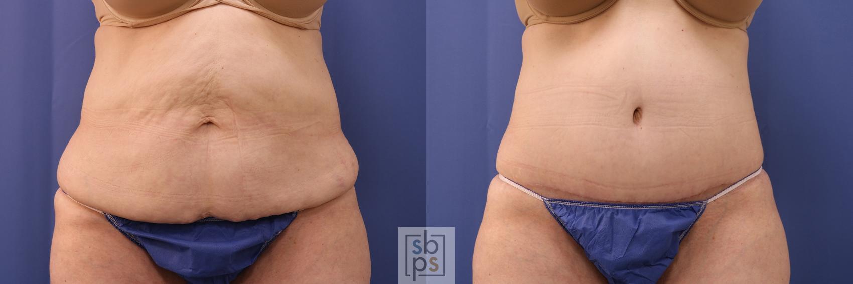 Before & After Tummy Tuck Case 395 Front View in Torrance, CA