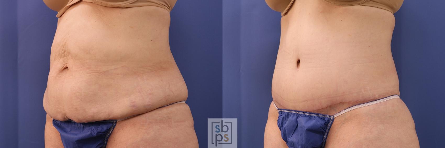 Before & After Tummy Tuck Case 395 Left Oblique View in Torrance & Los Angeles, CA, CA
