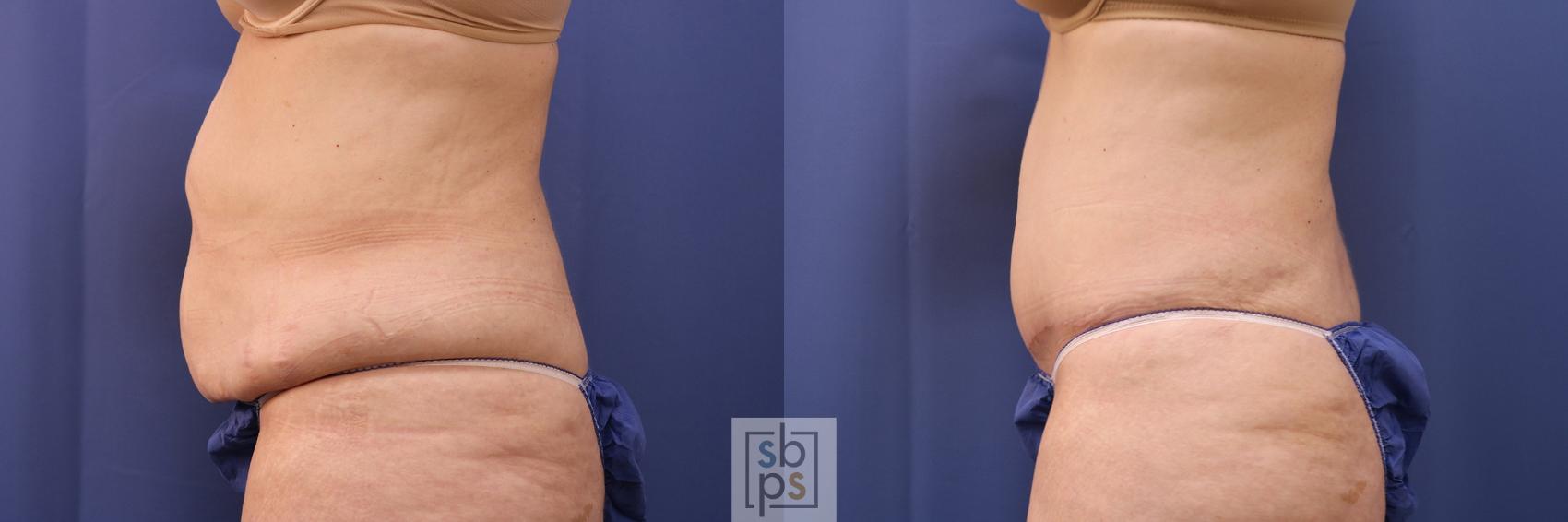 Before & After Tummy Tuck Case 395 Left Side View in Torrance & Los Angeles, CA, CA
