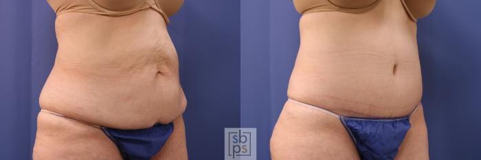 Before & After Tummy Tuck Case 395 Right Oblique View in Torrance, CA