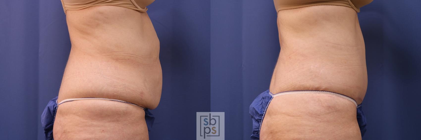Before & After Tummy Tuck Case 395 Right Side View in Torrance & Los Angeles, CA, CA