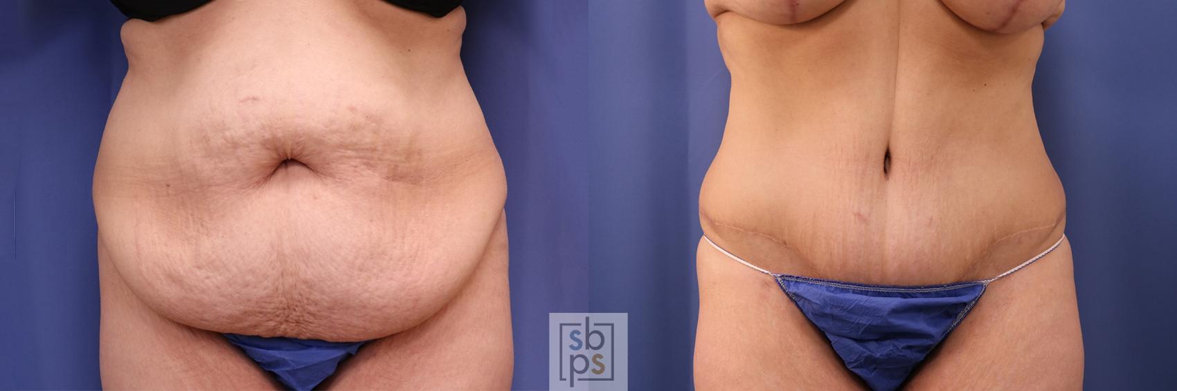 Before & After Tummy Tuck Case 402 Front View in Torrance, CA