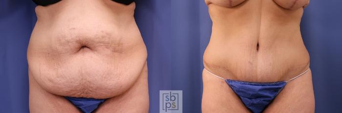 Before & After Tummy Tuck Case 402 Front View in Torrance, CA