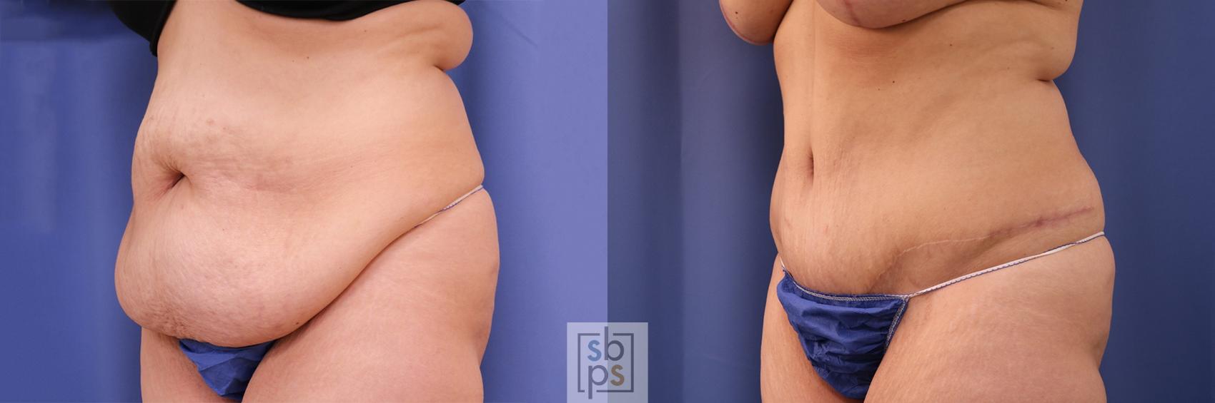 Before & After Tummy Tuck Case 402 Left Oblique View in Torrance & Los Angeles, CA, CA