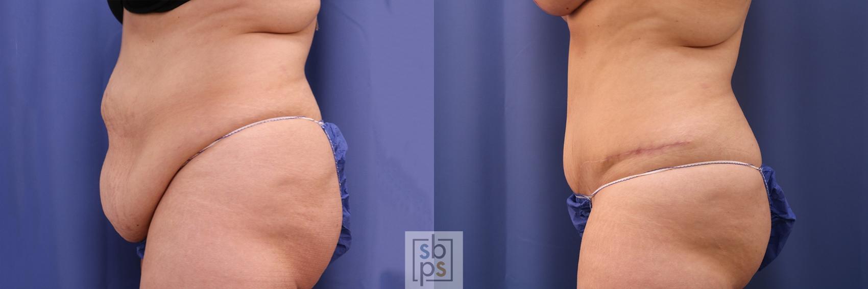 Before & After Tummy Tuck Case 402 Left Side View in Torrance & Los Angeles, CA, CA