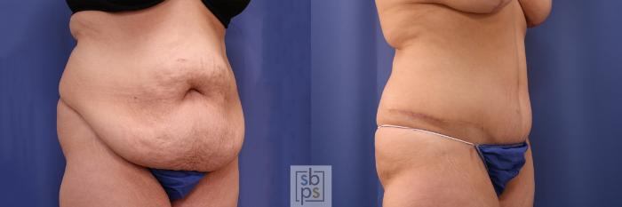 Before & After Tummy Tuck Case 402 Right Oblique View in Torrance, CA