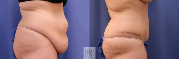 Before & After Tummy Tuck Case 402 Right Side View in Torrance, CA