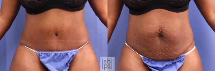 Before & After Tummy Tuck Case 432 Front View in Torrance, CA