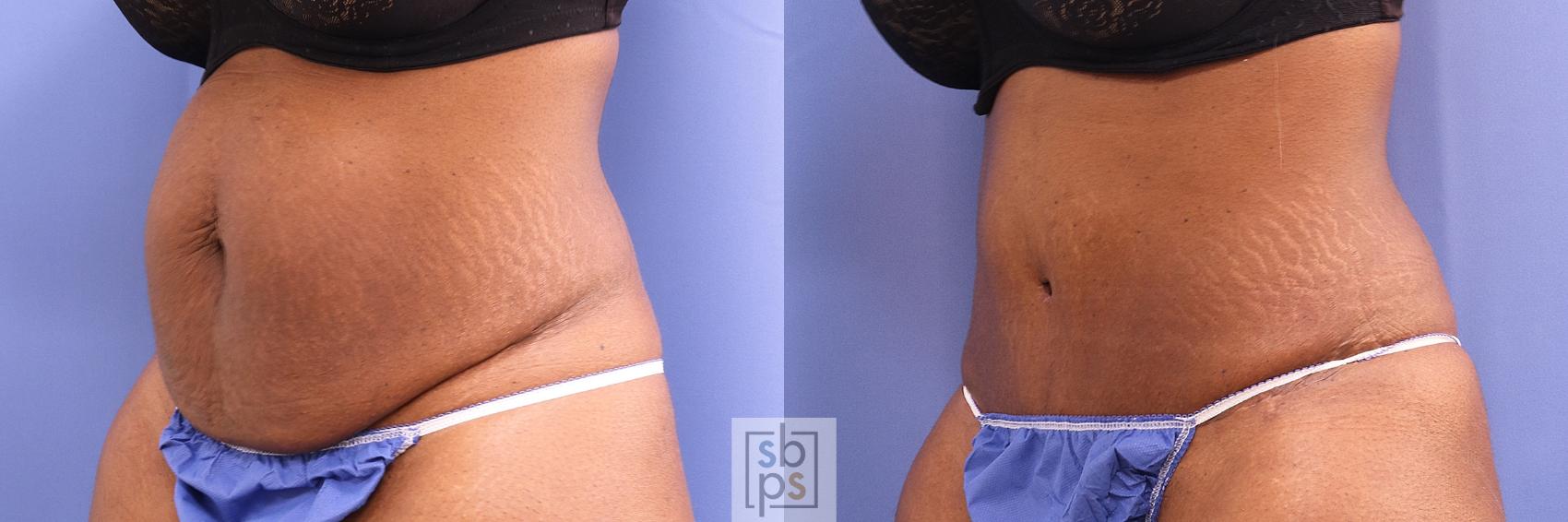 Before & After Tummy Tuck Case 432 Left Oblique View in Torrance & Los Angeles, CA, CA