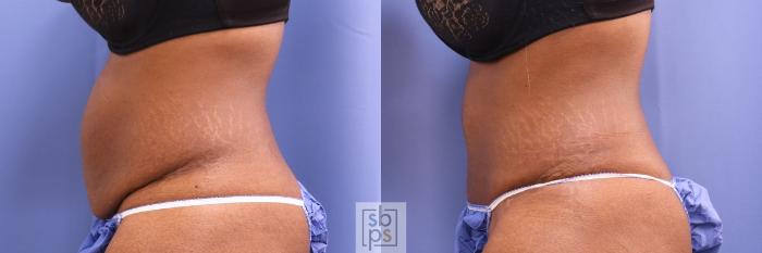 Before & After Tummy Tuck Case 432 Left Side View in Torrance, CA