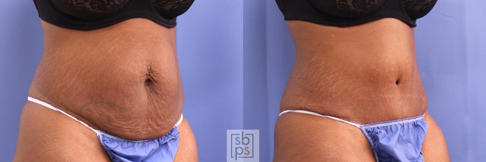 Before & After Tummy Tuck Case 432 Right Oblique View in Torrance & Los Angeles, CA, CA