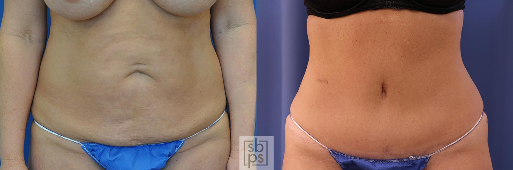 Before & After Liposuction Case 438 Front View in Torrance, CA