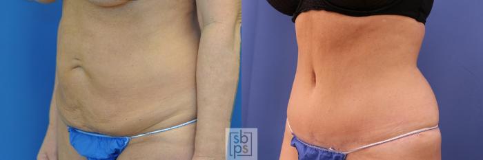 Before & After Liposuction Case 438 Left Oblique View in Torrance, CA