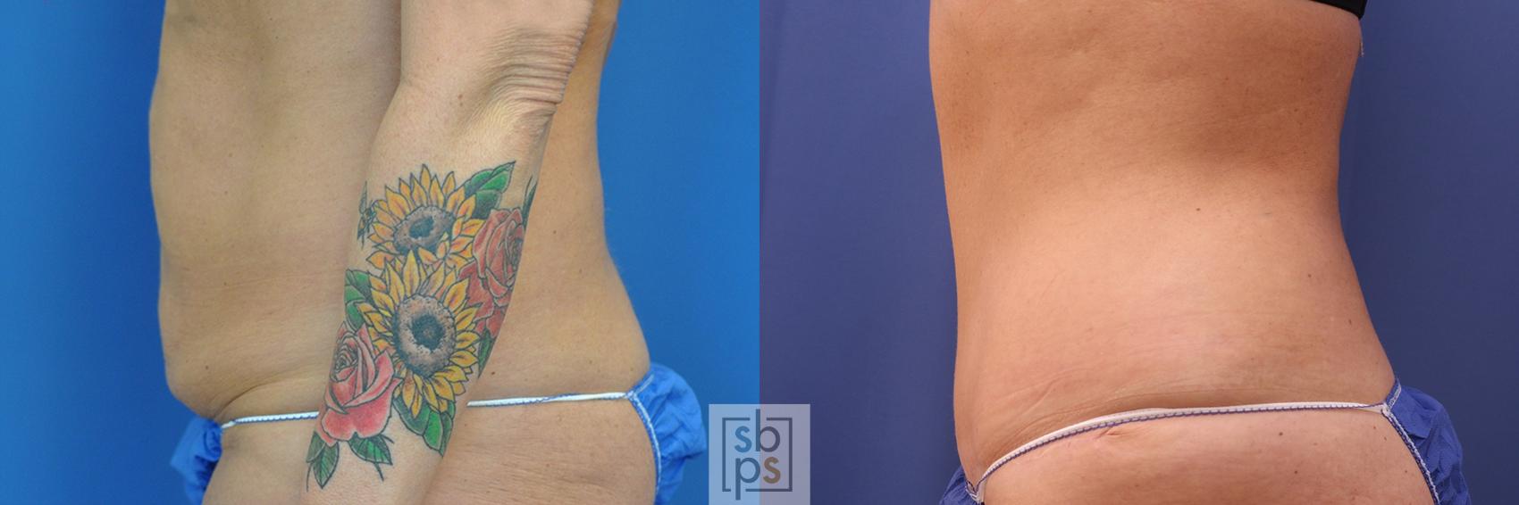 Before & After Tummy Tuck Case 438 Left Side View in Torrance & Los Angeles, CA, CA