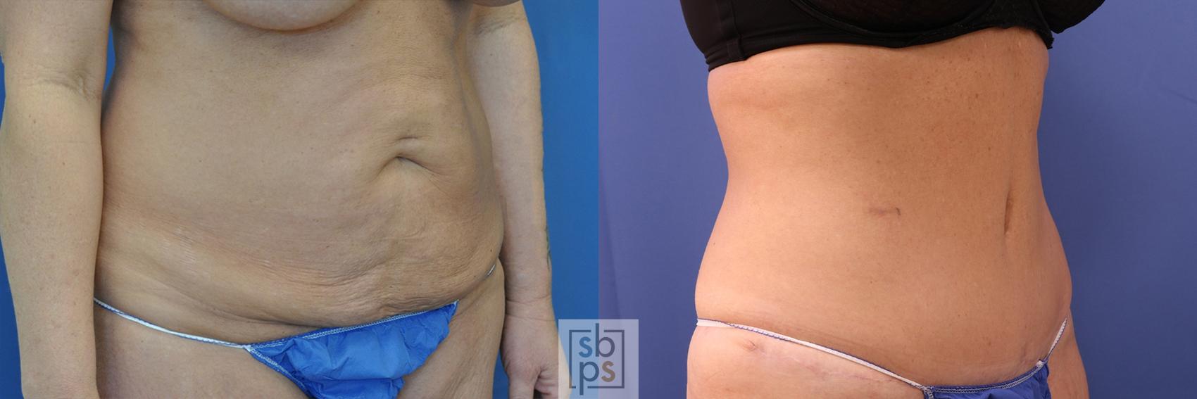 Before & After Tummy Tuck Case 438 Right Oblique View in Torrance & Los Angeles, CA, CA