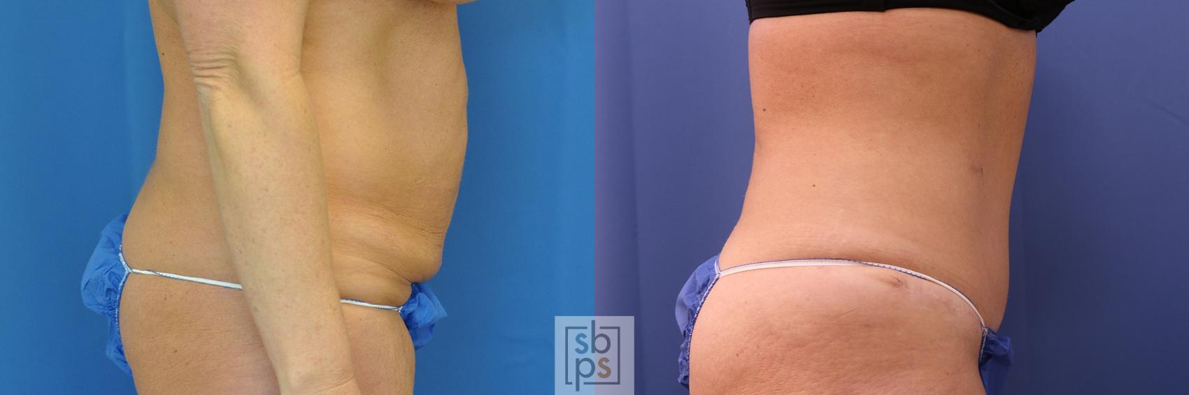 Before & After Tummy Tuck Case 438 Right Side View in Torrance & Los Angeles, CA, CA