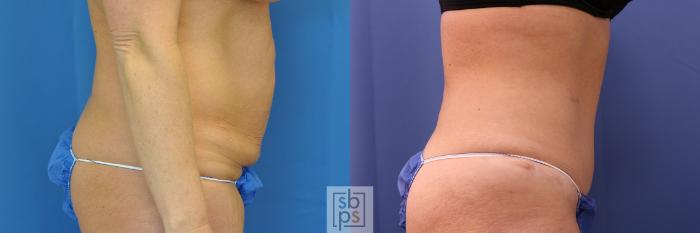 Before & After Tummy Tuck Case 438 Right Side View in Torrance, CA