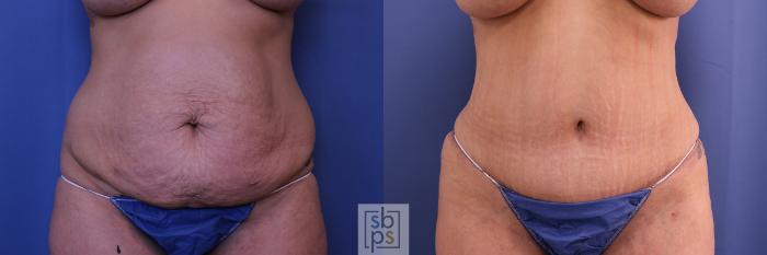 Before & After Liposuction Case 461 Front View in Torrance, CA