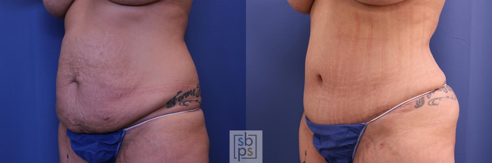 Before & After Tummy Tuck Case 461 Left Oblique View in Torrance & Los Angeles, CA, CA