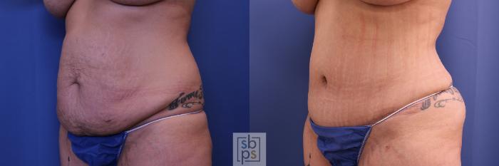 Before & After Tummy Tuck Case 461 Left Oblique View in Torrance, CA