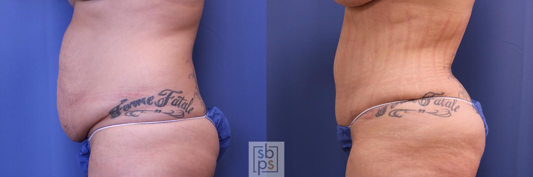 Before & After Tummy Tuck Case 461 Left Side View in Torrance & Los Angeles, CA, CA