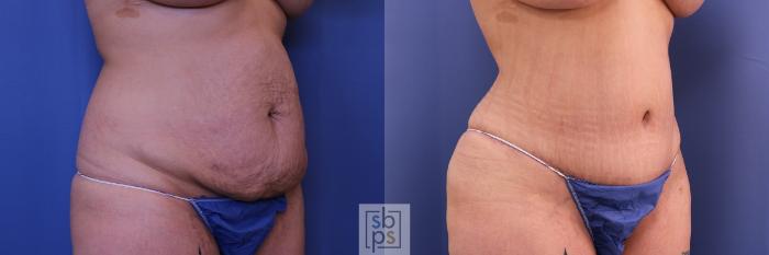 Before & After Tummy Tuck Case 461 Right Oblique View in Torrance, CA