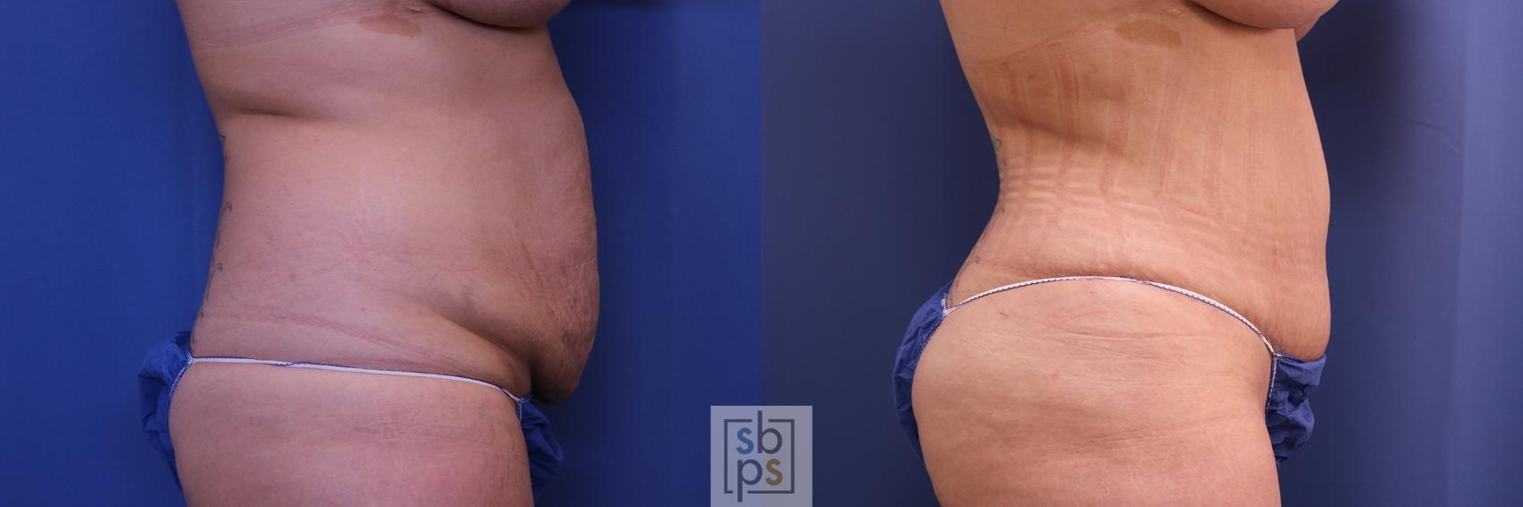 Before & After Liposuction Case 461 Right Side View in Torrance, CA