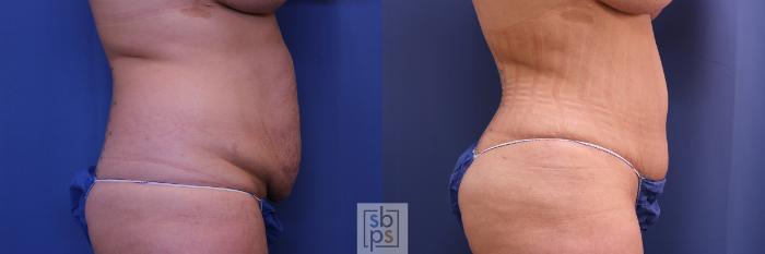 Before & After Tummy Tuck Case 461 Right Side View in Torrance, CA