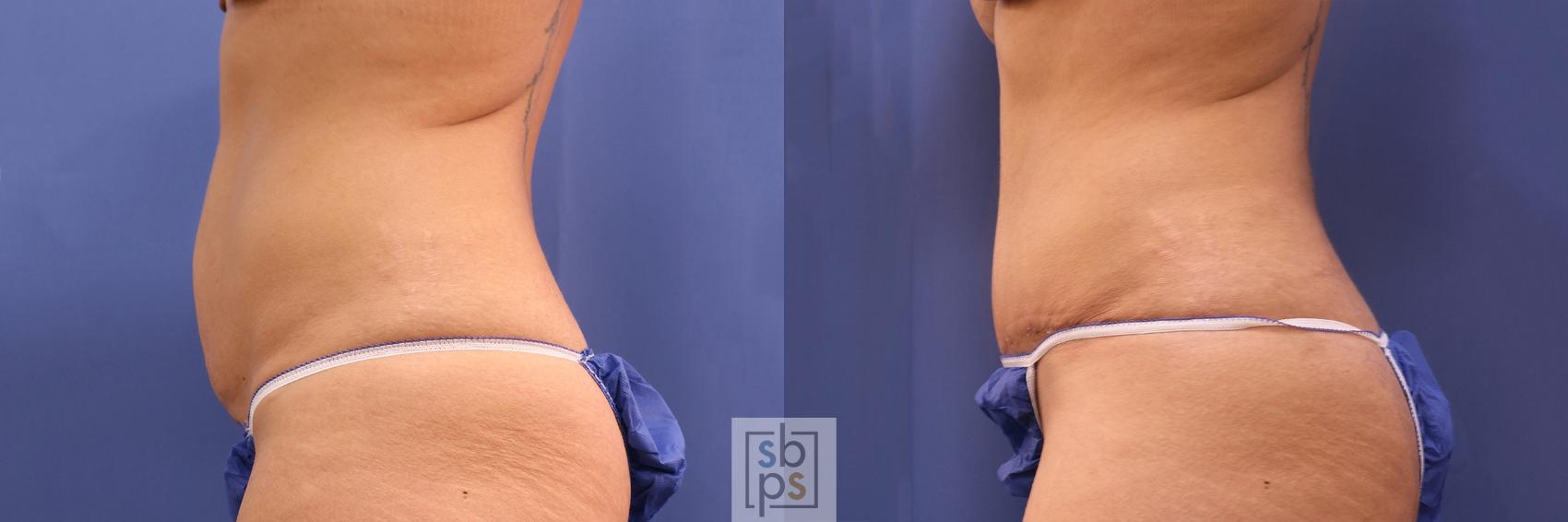 Before & After Tummy Tuck Case 465 Left Side View in Torrance & Los Angeles, CA, CA