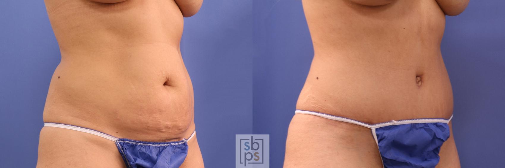 Before & After Tummy Tuck Case 465 Right Oblique View in Torrance & Los Angeles, CA, CA
