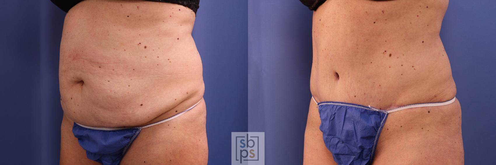 Before & After Tummy Tuck Case 471 Left Oblique View in Torrance & Los Angeles, CA, CA