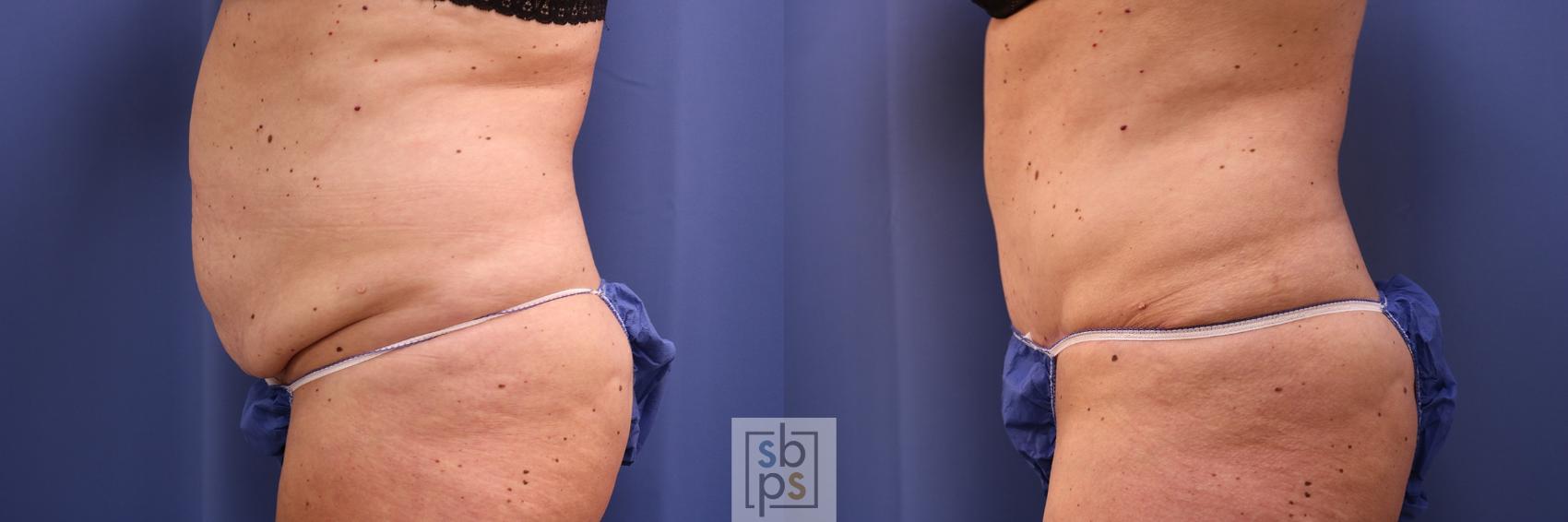Before & After Tummy Tuck Case 471 Left Side View in Torrance & Los Angeles, CA, CA
