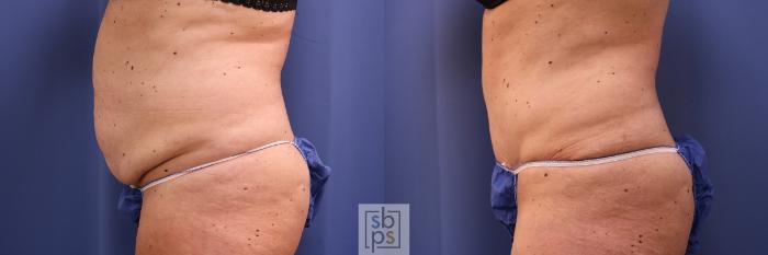 Before & After Tummy Tuck Case 471 Left Side View in Torrance, CA