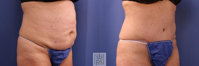 Before & After Tummy Tuck Case 471 Right Oblique View in Torrance, CA