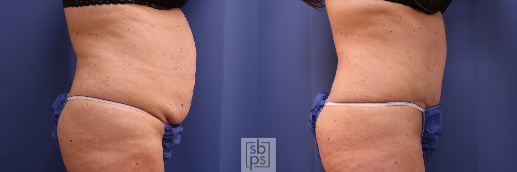 Before & After Tummy Tuck Case 471 Right Side View in Torrance & Los Angeles, CA, CA