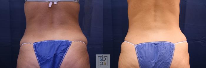 Before & After Tummy Tuck Case 473 Back View in Torrance, CA