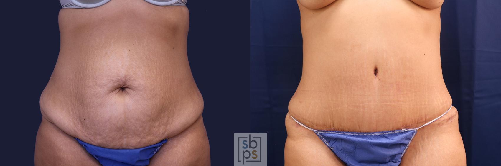 Before & After Tummy Tuck Case 473 Front View in Torrance, CA