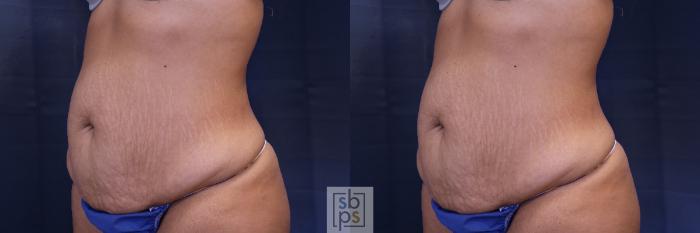 Before & After Tummy Tuck Case 473 Left Oblique View in Torrance, CA