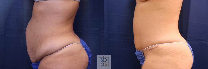 Before & After Tummy Tuck Case 473 Left Side View in Torrance, CA