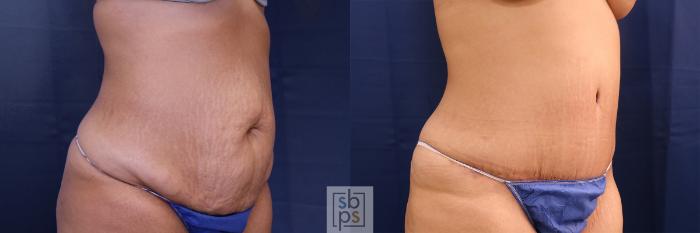 Before & After Tummy Tuck Case 473 Right Oblique View in Torrance, CA