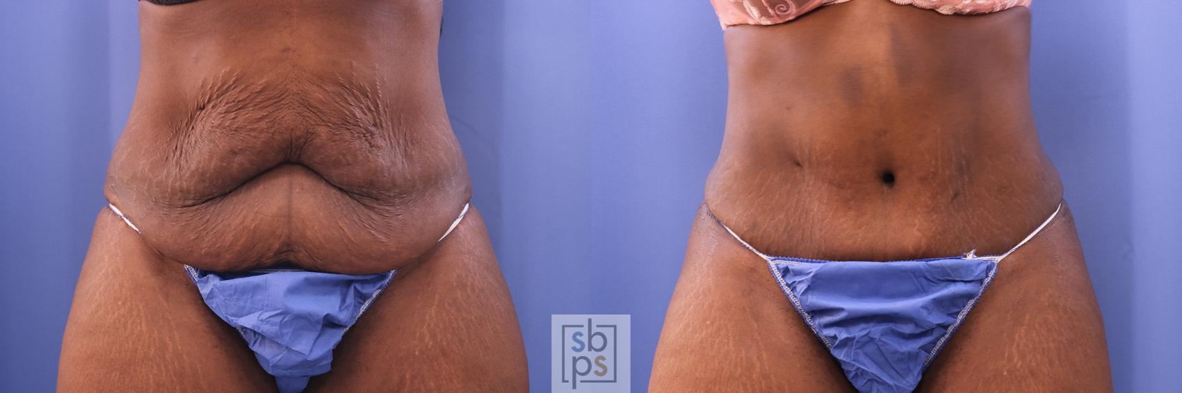 Before & After Liposuction Case 475 Front View in Torrance, CA